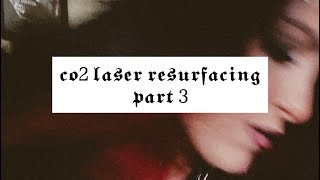My Co2 Laser Resurfacing journey part 3