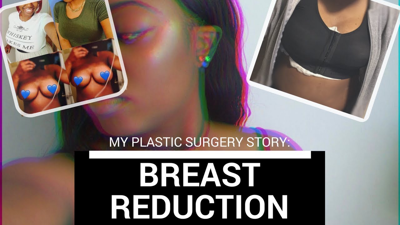 My Plastic Surgery Story:Breast Reduction(36G to 36C/D) 