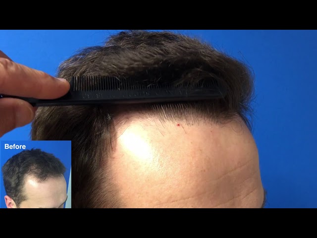 Hair Transplant Case Study and Combthrough   Hartford, CT 1