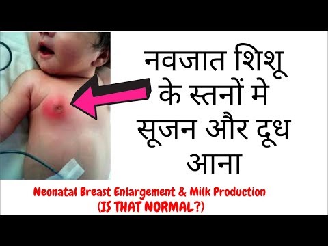 वीडियो: नवजात शिशु में स्तन ग्रंथियां क्यों सूज जाती हैं?