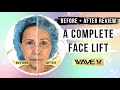 SMAS Facelift Before and After: Amazing Full Face Transformation | Wave Plastic Surgery