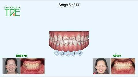 Điều trị khớp cắn ngược bằng chỉnh nha trong suốt Invisalign