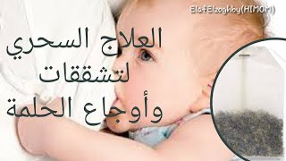 العلاج السحري لتشققات وأوجاع الحلمة