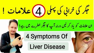Your Liver is Dying 4 Weird Signs & Symptoms of Liver Problems In Urdu Hindi - Irfan Azeem