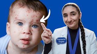 How to treat chickenpox on eyebrow near eye Chickenpox Symptoms Pharmacistvirginia Nhs Shorts