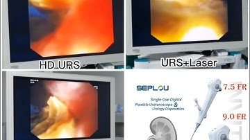 Ureteroscope (URS) factory-Seplou. HD definitdefinitionion 160K pixels.Super clear vision.
