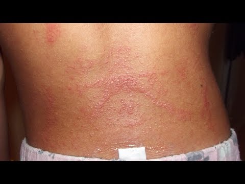 Video: Si të shmangni infeksionin Elizabethkingia (me fotografi)