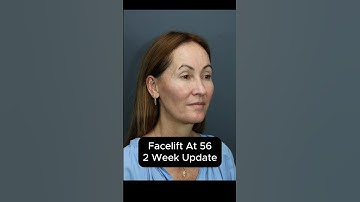 Facelift At 56 - 2 Week Update (Interview) #facelift