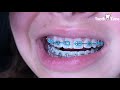 Braces Checkup - Fast Appointment Changing Elastics  - Tooth Time Family Dentistry New Braunfels