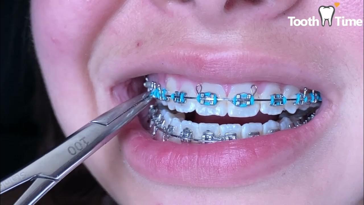 Braces Checkup Fast Appointment Changing Elastics Tooth Time Family