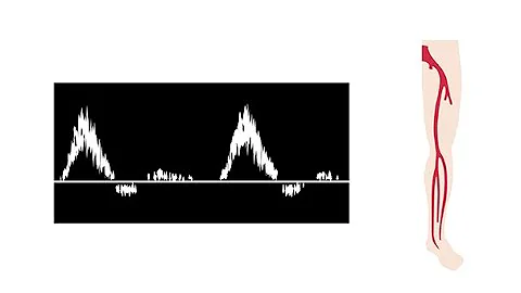 Interpreting duplex waveforms