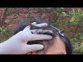 Dandruff scratching removal on head using black combing #E378