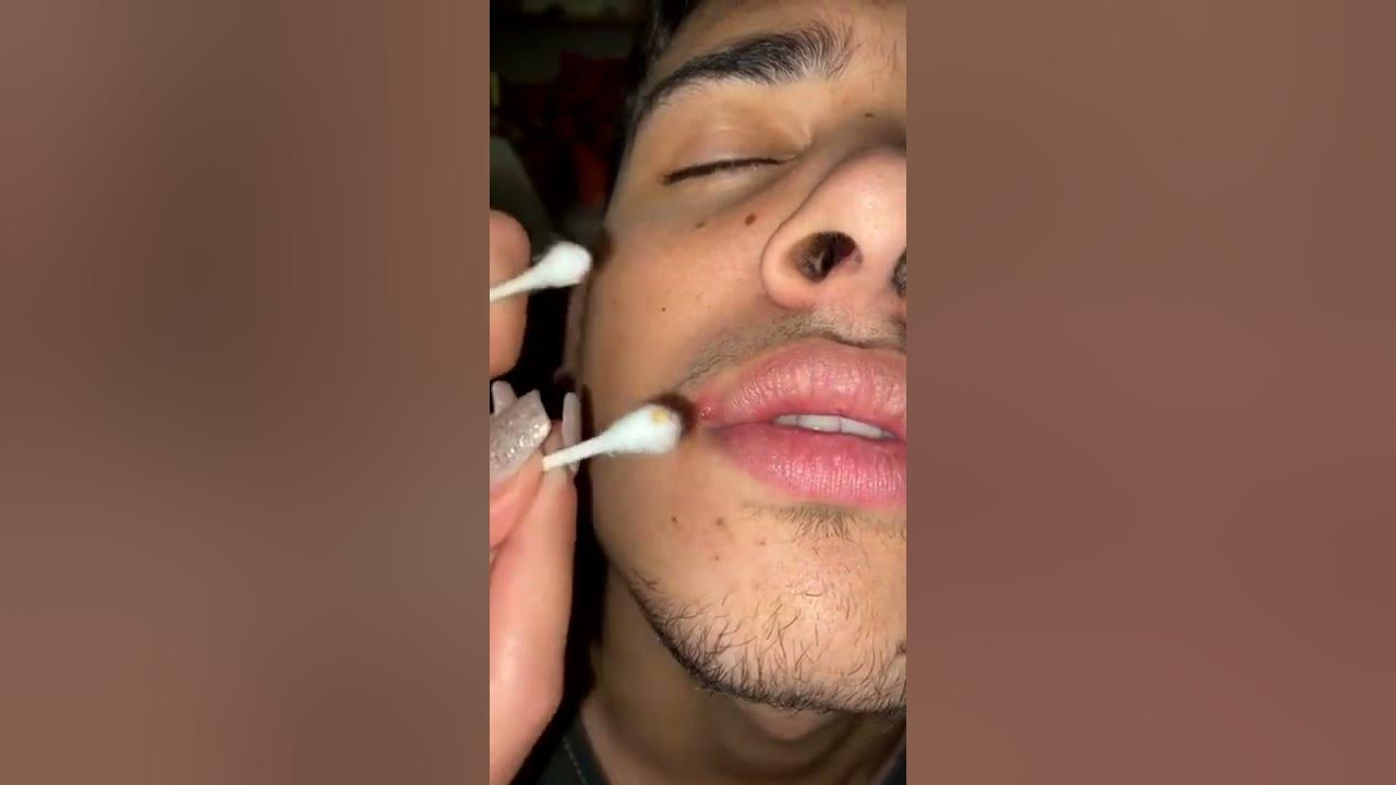 Removing pimples from back Cyst removal loan nguyen YouTube