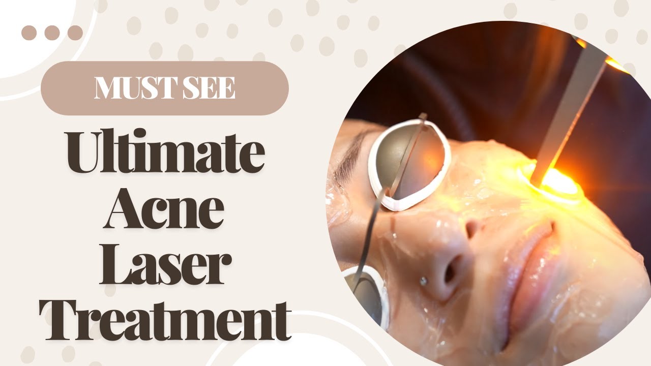 The Best Acne Scar Laser Treatment! Barrett MedSpa YouTube