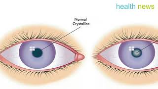 How to Remove a Cataract and Get 20⁄20 Vision with Castor Oil