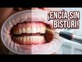 Corte de Encía Usando Lasser