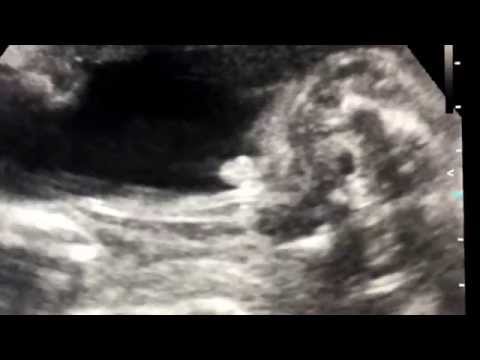 24 haftalık erkek fetus anne rahminde çişini yaparken..
