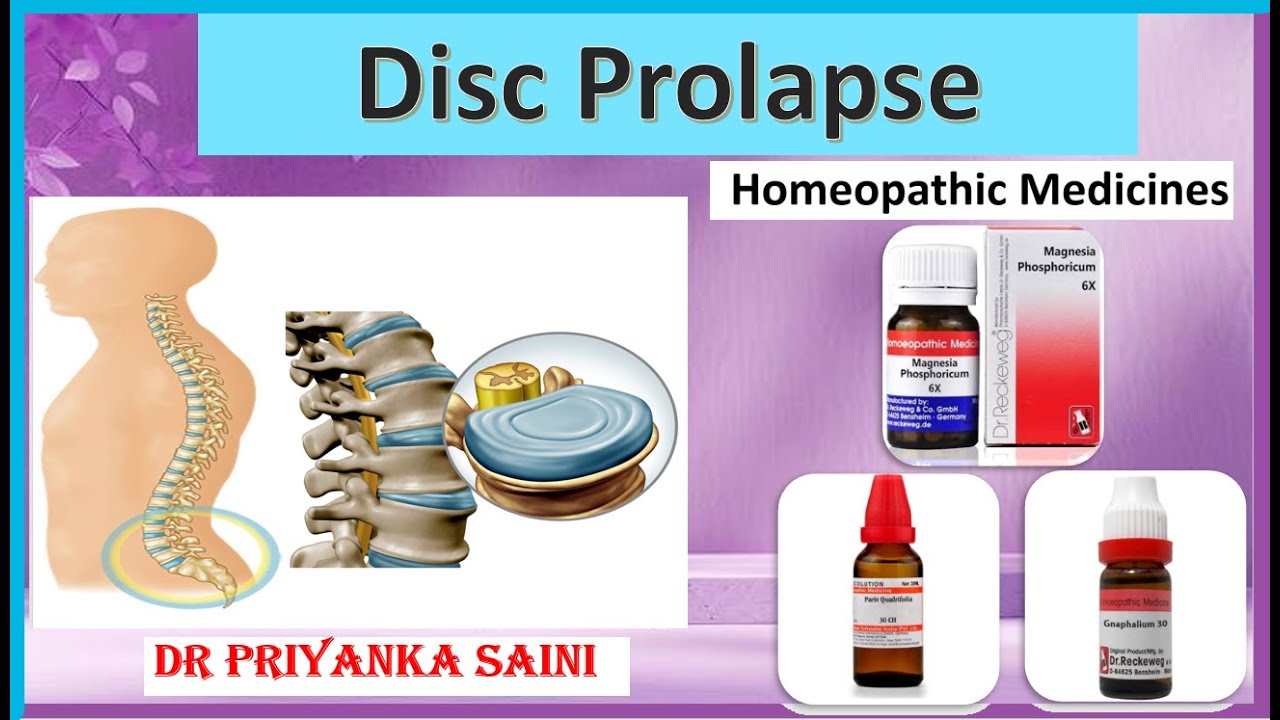Disc prolapse /slipped disc/herniated homeopathy Treatment dr