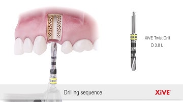 XiVE™ − Drilling sequence and implant placement | DENTSPLY