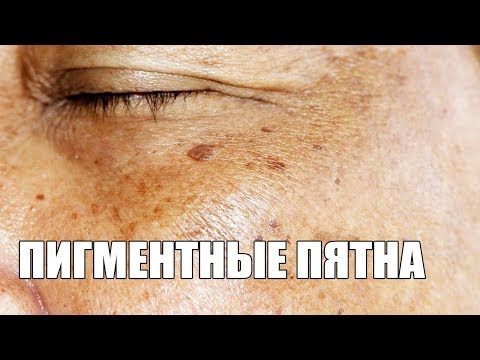 Удаление возрастных пятен с помощью народных методов