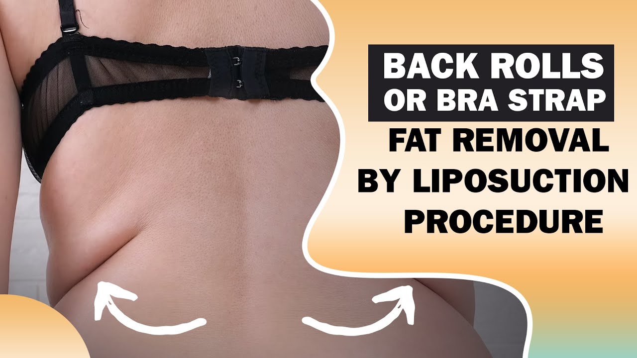 Back Rolls / Bra Strap Fat Removal, Liposuction in Delhi