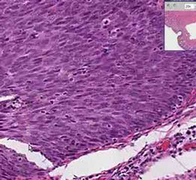 Video: Puas squamous metaplasia txhais tau tias mob qog noj ntshav?