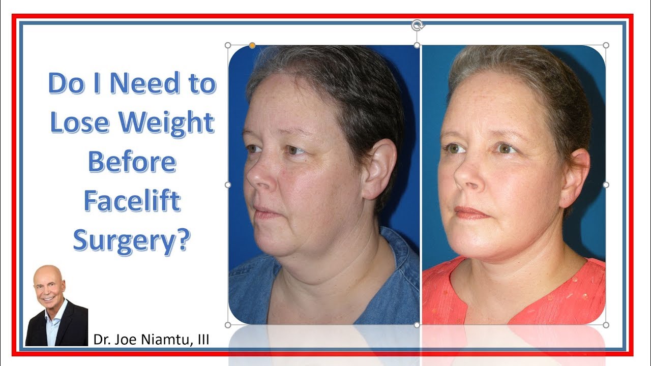 Do I need to Lose Weight Before Facelift Surgery? - YouTube