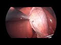 Changing L - Hook to left hand for better dissection