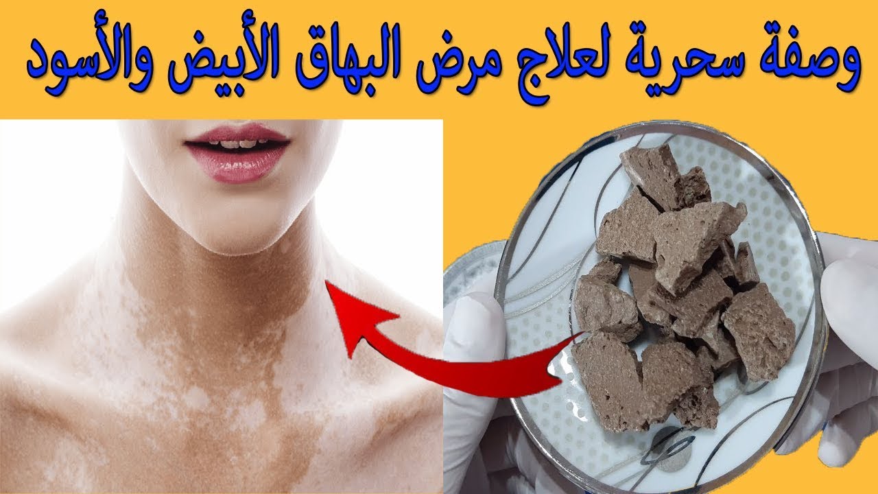 مكون يقضي على مرض البهاق الأبيض والاسود كليا ويعيد بناء لون البشرة كما كانت بشكل سريع أقوى علاج مجرب youtube blog blog posts مكون يقضي على مرض البهاق الأبيض والاسود كليا ويعيد بناء لون البشرة كما كانت بشكل سريع أقوى علاج مجرب youtube blog blog posts
