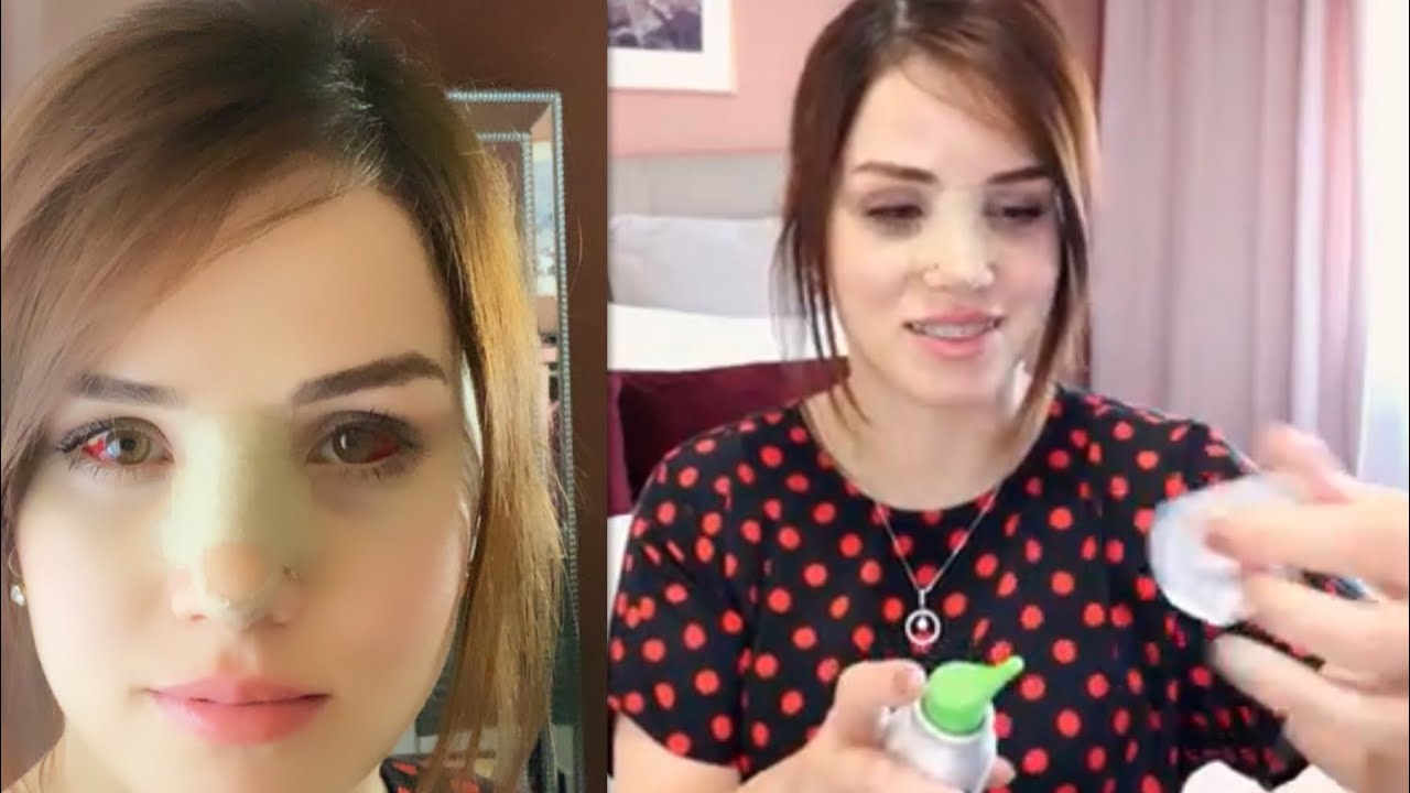 مابعد عملية الانف😱 قريت اسئلتكم حول العملية 😉