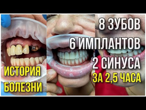 Удалили 8 зубов. Поставили 6 имплантов и сделали 2 синуса меньше чем за 3 часа.