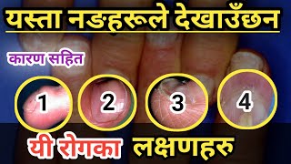 नङको सेतो दाग धर्काहरुले दिने सँकेतहरु symptoms and causes of nail problems || Nepali Health Tips