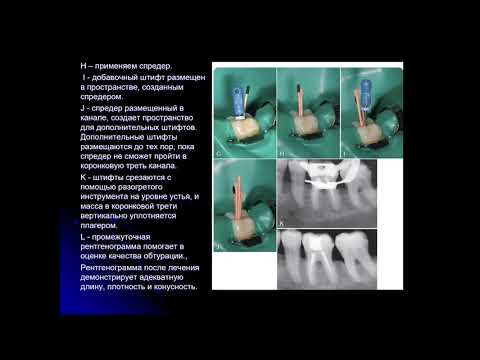 Эндодонтия 6.Методы обтурации корневых каналов зуба