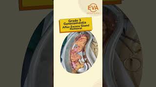 Grade 3 Gynecomastia of 19 year boy | Gynecomastia Surgery in Delhi | Dr.Hiranmayi Jha