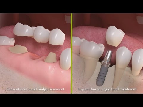 Video: Dentalfaner: Kostnad, Procedur Kontra Krona, Implantat Och Mer