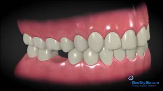 🦷 Missing Teeth Replacement: Discover Your Path to a Confident Smile with Kyle Parkway Dentistry! 🦷