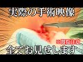 化膿した粉瘤 炎症性粉瘤 の治療 実際の手術の様子をお見せします 化膿した粉瘤 炎症性粉瘤 の治療 実際の手術の様子をお見せします