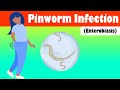 Pinworm infection enterobiasis  causes signs  symptoms treatment