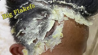 DRY SCALP !! Big Flakes Dandruff Scratching #127