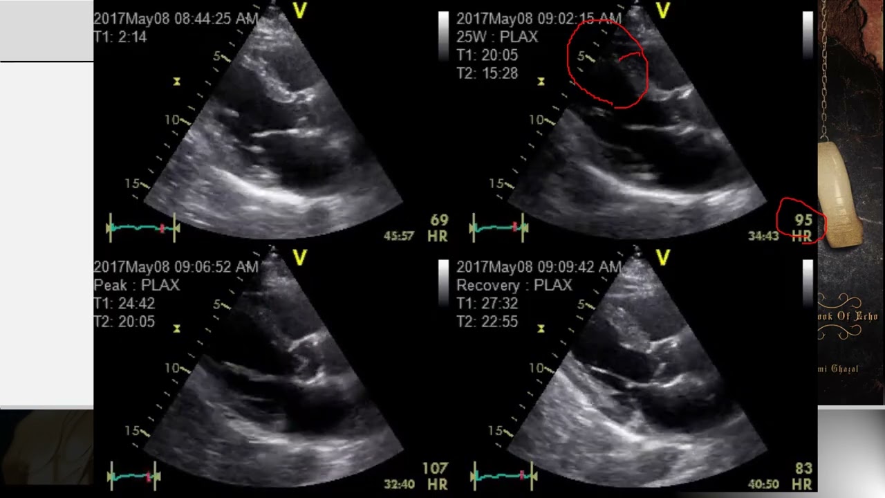 Lecture 15 - Stress Echocardiography