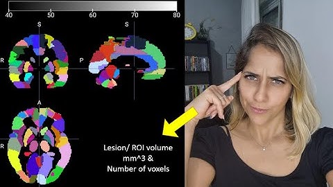 ROI (or lesion) volume , number of voxels and overlap with anatomical regions using the MRIcroGL©