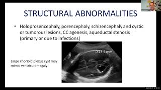 Mild ventriculomegaly: A big problem? (Vedran Stefanovic)