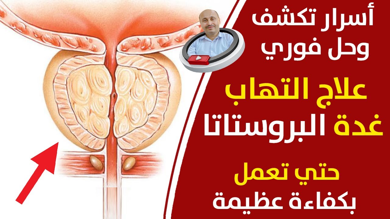 احتقان غدة البروستاتا حل سحري لعلاج احتقان البروستاتا وكل من يعاني من مشاكل التهاب البروستاتا تضخم