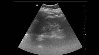 CASE 1072 ABUS gall bladder stones