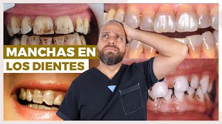 DIENTES MANCHADOS 😟 [ Tipos de Manchas y Qué las PRODUCE ] 😭