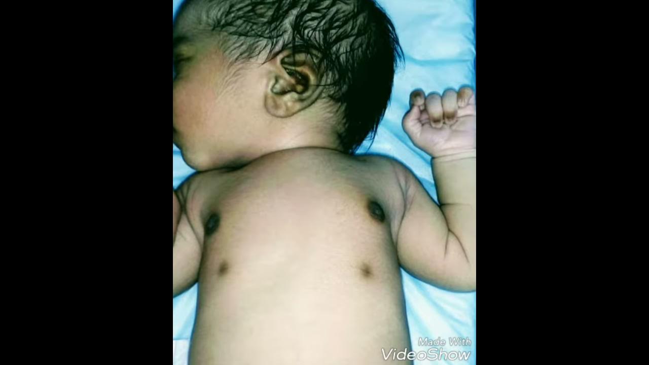Accessory nipple in a newborn Supernumerary nipples Newborn Congenital Malformations