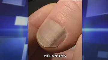 What does it mean when nail fungus turns black?