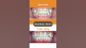 Hành trình LỘT XÁC nhờ niềng răng của Nguyễn Thị Nga