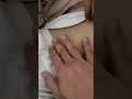 شاهد الmucBurny signs لمريض التهاب الزايده الدوديه