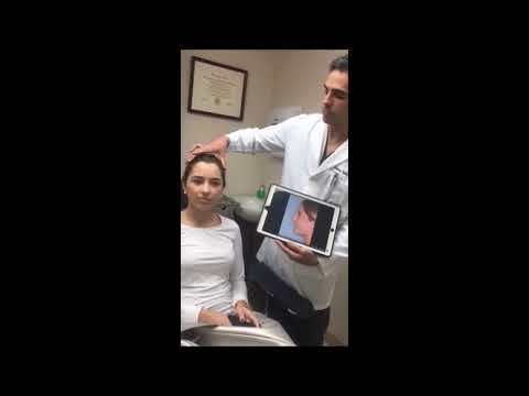 Video thumbnail: Rhinoplasty for Hanging Columella and Flared Nostrils | Dr. Anthony Bared, MD, FACS Miami, FL